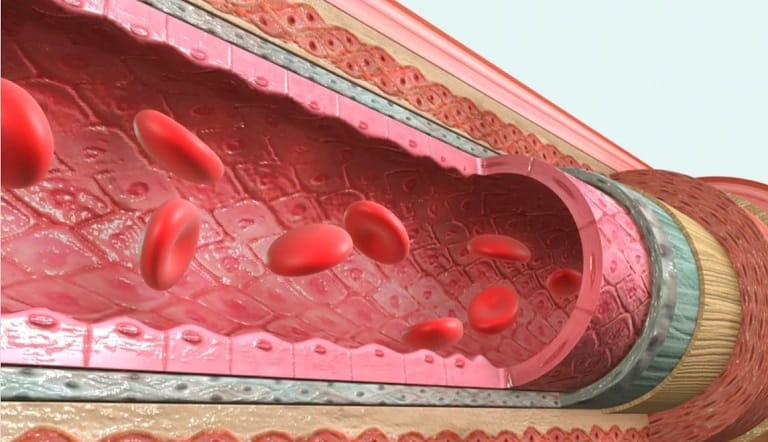 CALCIPHYLAXIS AND PERIPHERAL ARTERY DISEASE